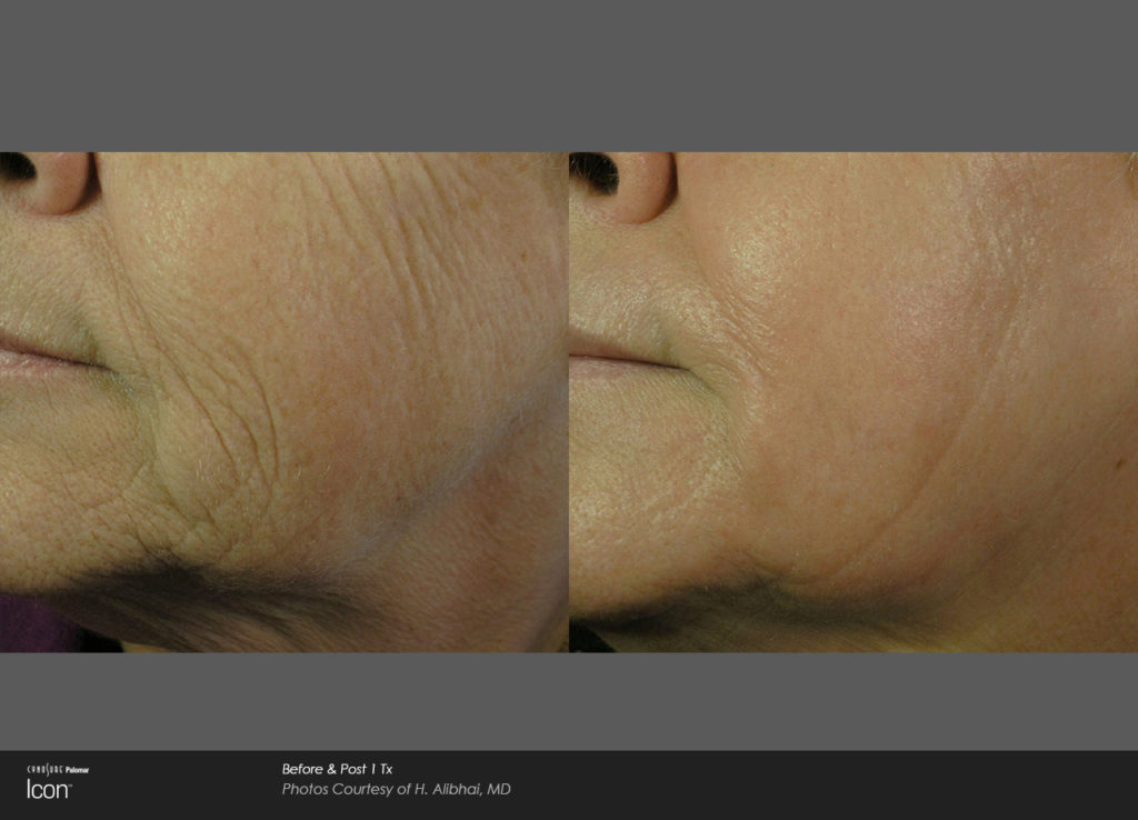 Skin-Resurfacing-Before-_-After-Photo-2