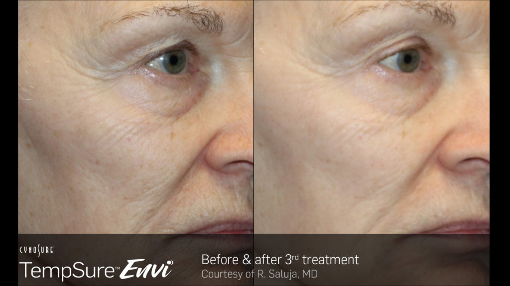 TempSure-Envi-Before-and-After-Image_8