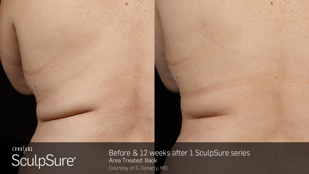 marketing_materials_BA_SculpSure_S.Doherty_Back-2_1tx_12weeks.2
