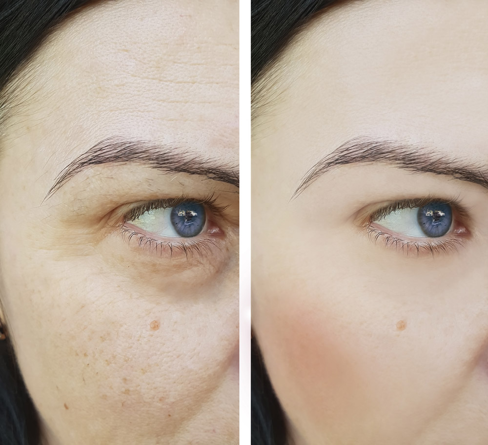 woman face wrinkles before and after pigmentation