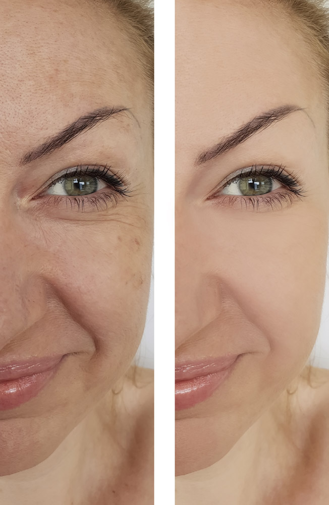 face woman wrinkles before and after pigmentation
