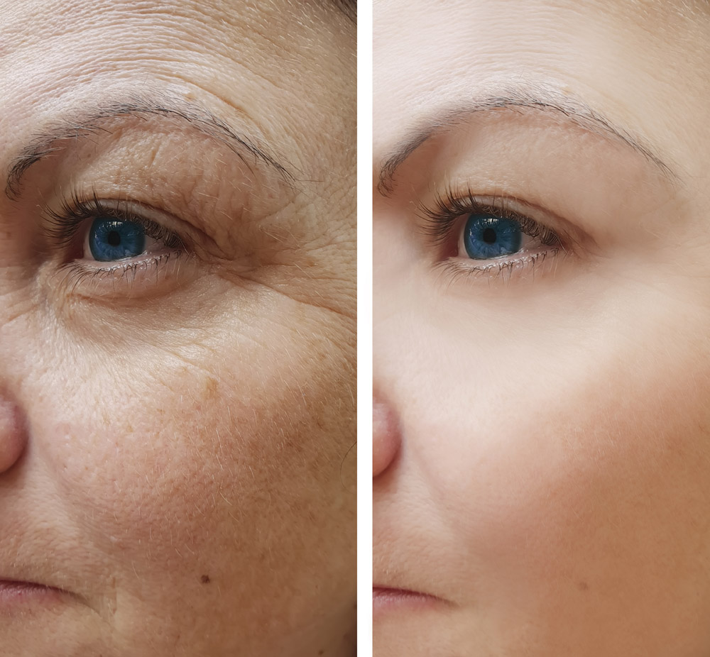 wrinkles face woman before and after procedures, pigmentation