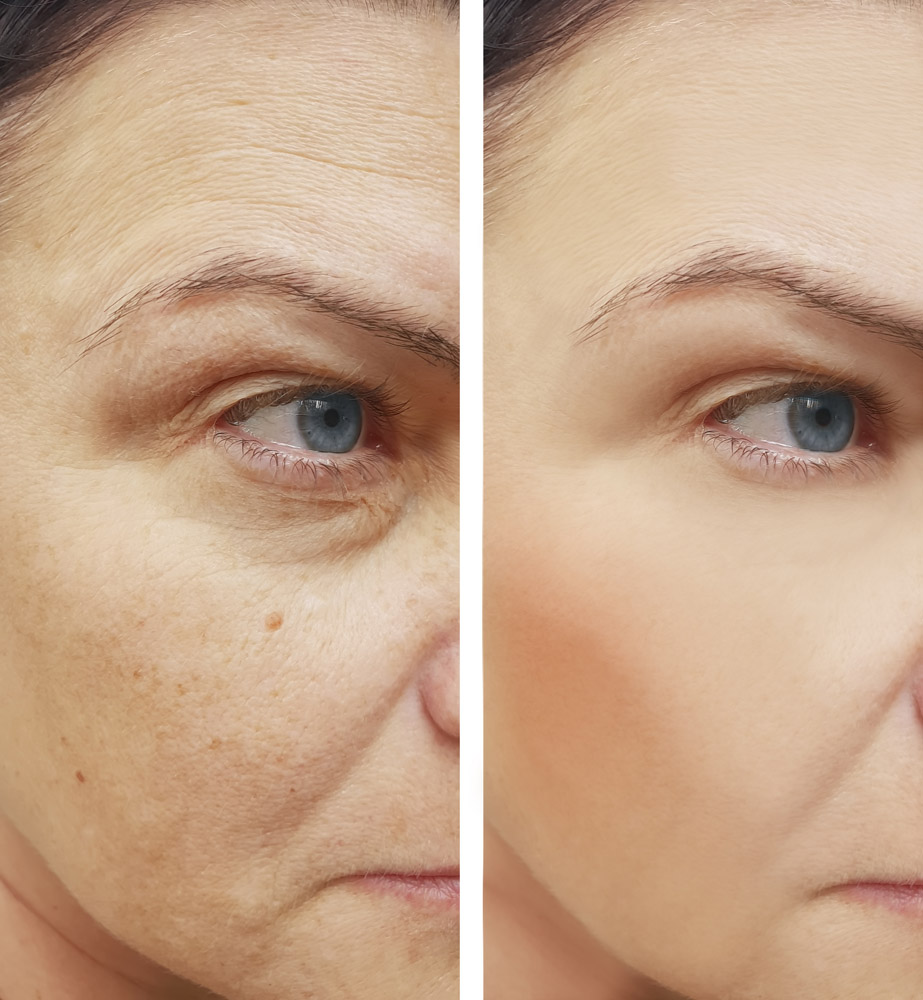 wrinkles face woman before and after procedures, pigmentation