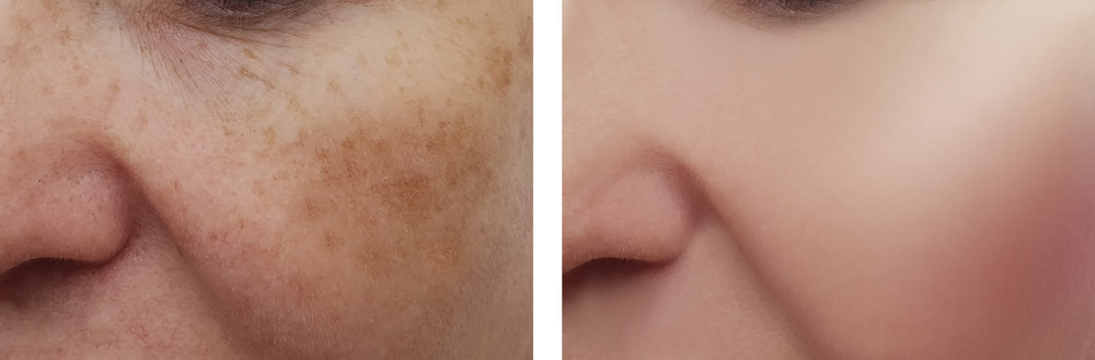 woman face wrinkles pigmentation before and after procedures