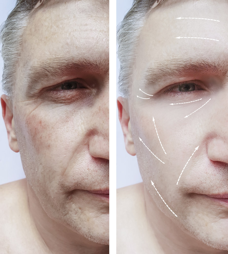 male face wrinkles before and after treatments, pigmentation