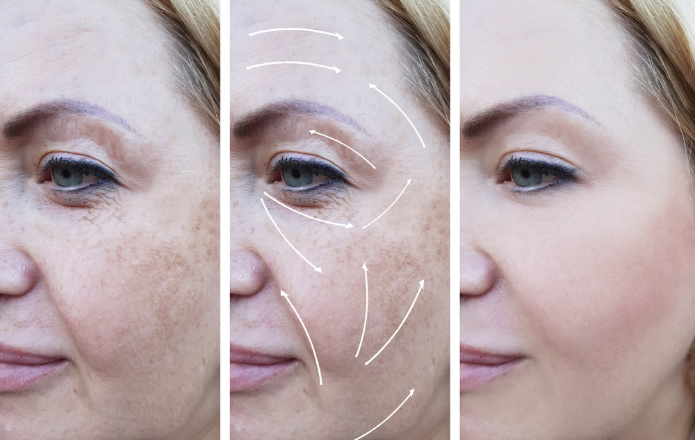 woman wrinkles correction before and after procedures, arrow, pigmentation