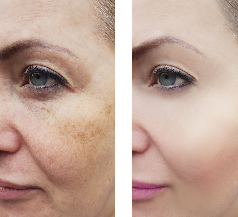 wrinkles woman face before and after pigmentation retouch